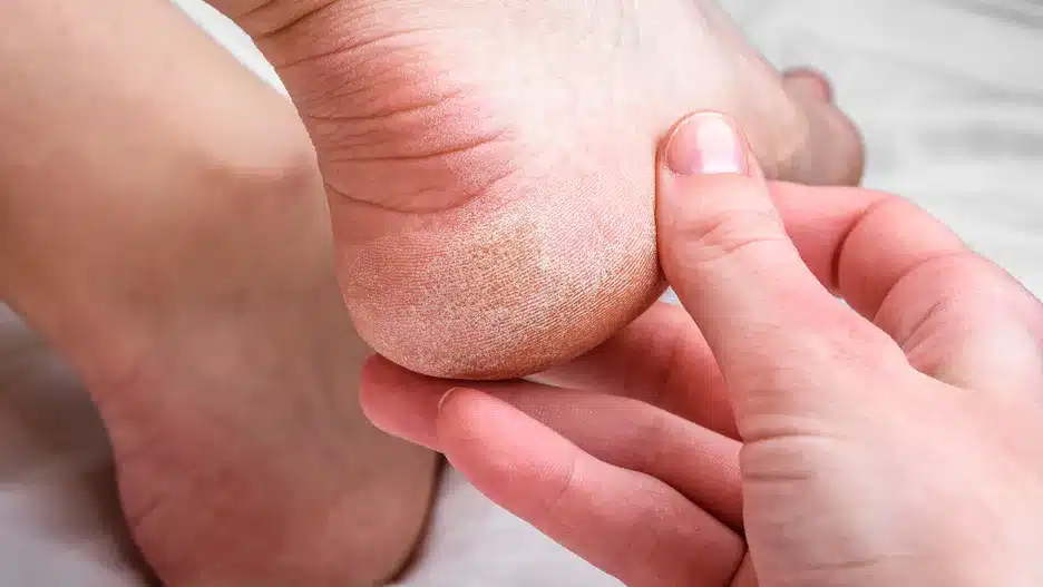 Vtírejte do suchých pat. Budou hladké jako u miminek.